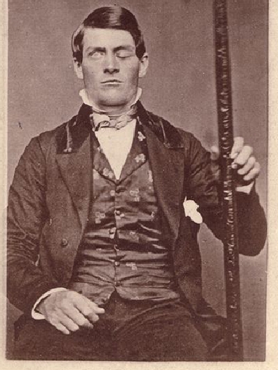 Một bức chân dung của Phineas Gage được vẽ sau khi ông bị thanh sắt xuyên qua đầu. Ông cầm thanh sắt gây nên vụ tai nạn